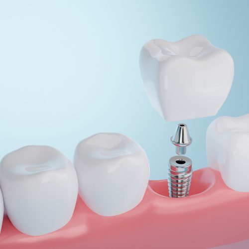 Healthy gums and Dental implant on blue background